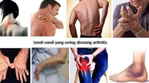 Illustration for article titled Obat Herbal Untuk Mengobati Penyakit Asam Urat